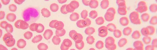 What Does Undetectable Viral Load Mean?