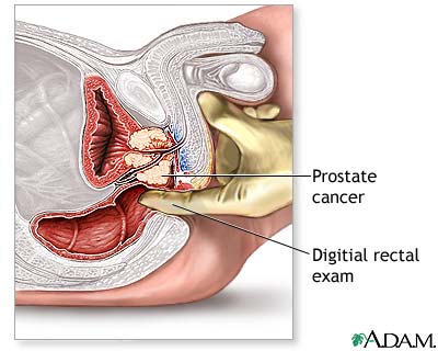 a prosztata prostat