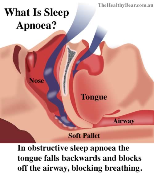 what is sleep apnoea