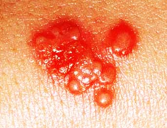 herpes rash